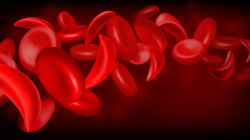 Hematologists Consider Where New Therapies Fit In Sickle Cell Treatment Paradigm